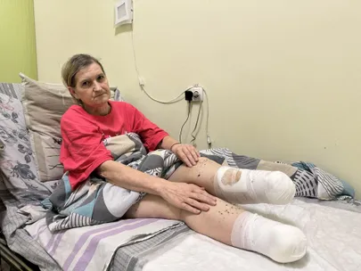 После атаки дрона Тамила Солодкова лишилась обеих ног ниже колен.